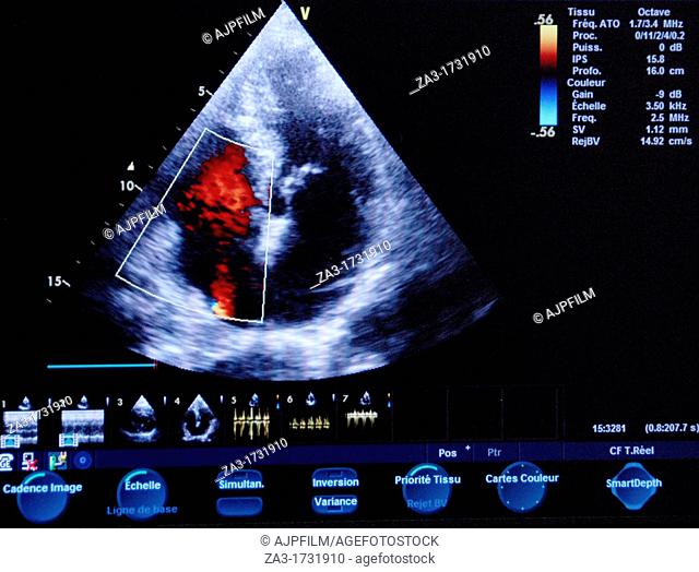Cardiology exam Echocardiography  Middle aged patient undergoing a heart ultrasound scan  A transducer held against his chest emits ultrasonic waves and detects...