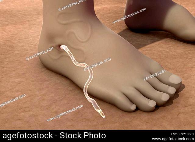 Guinea worm disease, dracunculiasis, 3D illustration. A disease caused by nematode roundworm Dracunculus medinensis, it occurs by drinking unfiltered water...