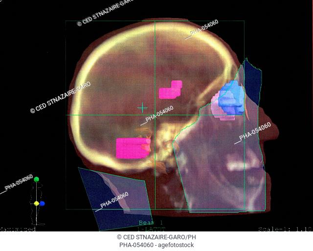 Three-dimensional Computed Tomograpgy CT scan of the brain showing mapping of a radiotherapy treatment of brain metastasis from a colon cancer