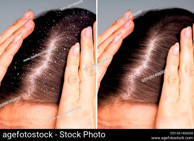 Difference Of Hair With Dandruff And Clean Hair