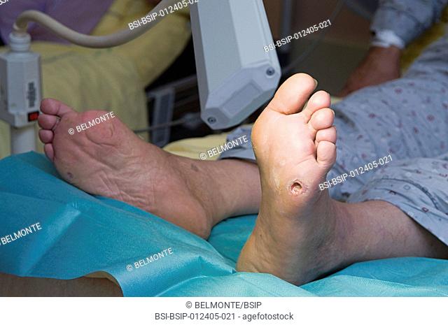 Photo essay in the department of diabetology at Saint-Louis hospital, Paris, France. Diabetic foot ulcer