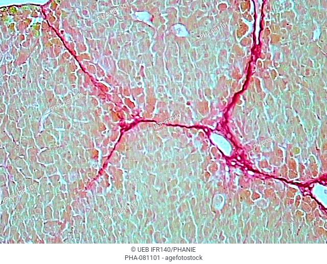 Photomicrograph of of liver tissu with collagen fibers in pink