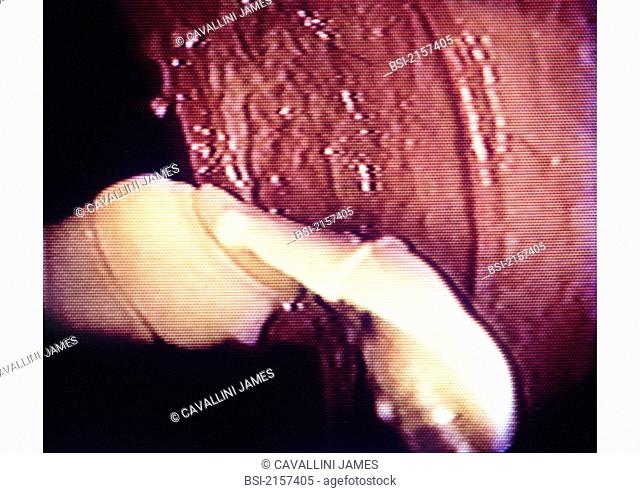 Tenia, or tapeworm, a parasitic worm of the intestin. Colonoscopy fiberscopy of the colon