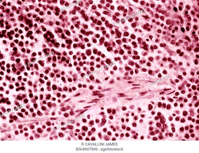 MULTIPLE MYELOMA, BONE MARROW Multiple myeloma. Section view of the bone marrow