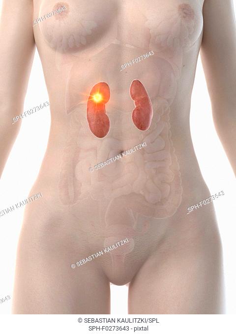 Kidney cancer, conceptual computer illustration