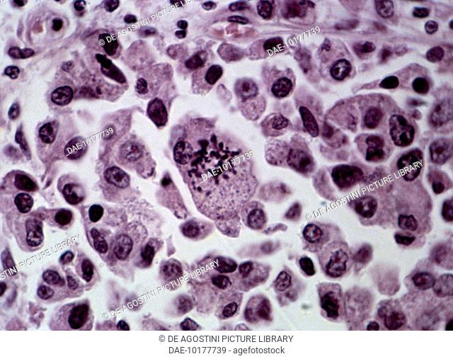 Section of malignant connective-tissue tumour from a human seen under a microscope