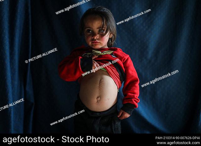 07 March 2021, Syria, Idlib City: A picture made available on 14 March 2021 shows Syrian girl Samiha Zakaria Seri, 4, lifting up her shirt to show the extent of...