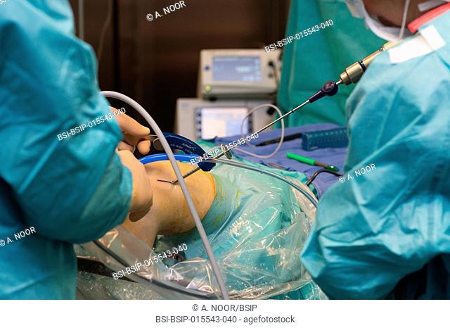 Reportage in the orthopedic surgery service in Saint George Clinic, Nice, France. Treating a torn cruciate ligament with ligament surgery using the Sambba...
