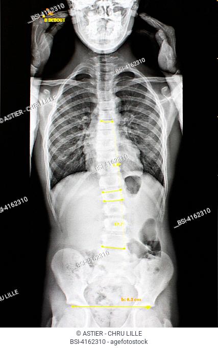 SCOLIOSIS, X-RAY