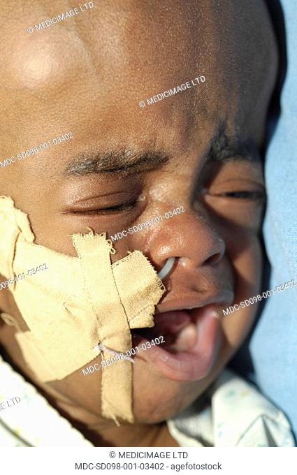 Close up of a small child suffering from hydrocephalus, a condition in which excessive Cerebrospinal fluid CSF production leads to a build up of pressure within...