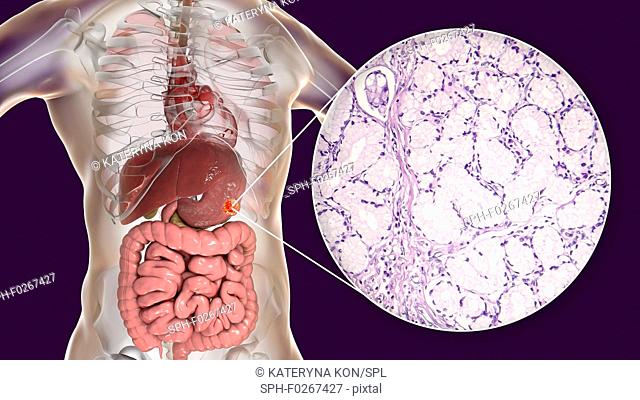 Human stomach mucinous adenocarcinoma, computer illustration and light micrograph