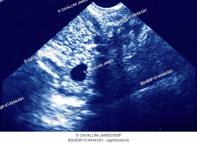 Extra-uterine (ectopic) pregnancy seen on an abdomino-pelvic scan