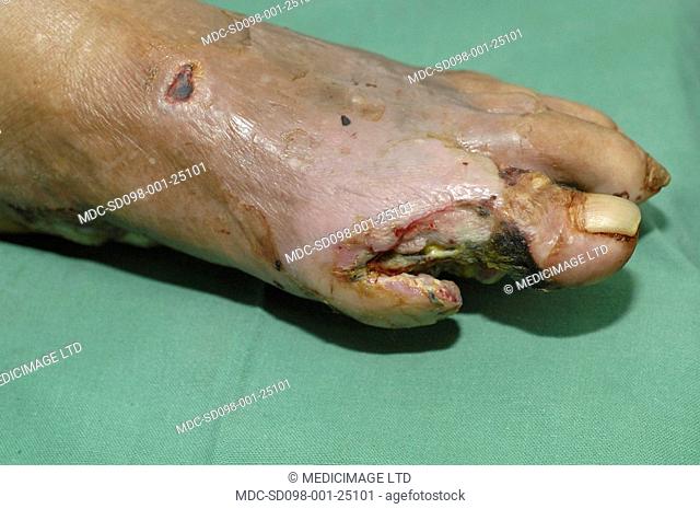 The foot has had a widespread destruction of tissues due to bacterial infection./nDiabetics are already more susceptible to bacterial infections as high blood...