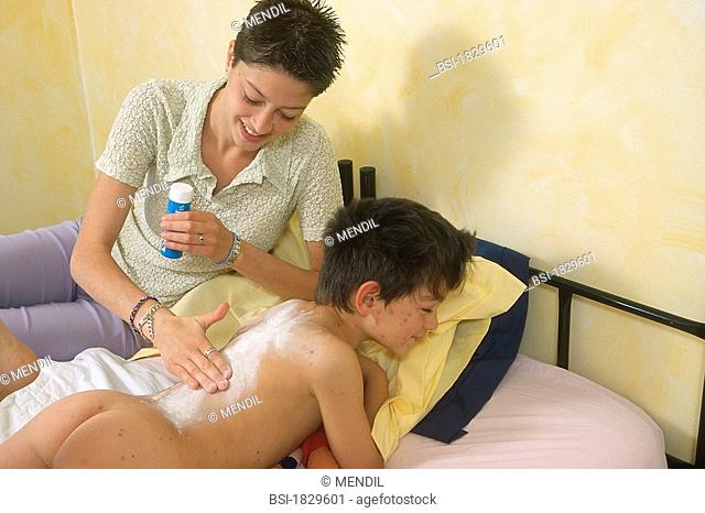 CHICKENPOX<BR>Models.<BR>Applying talcum powder to relieve itching