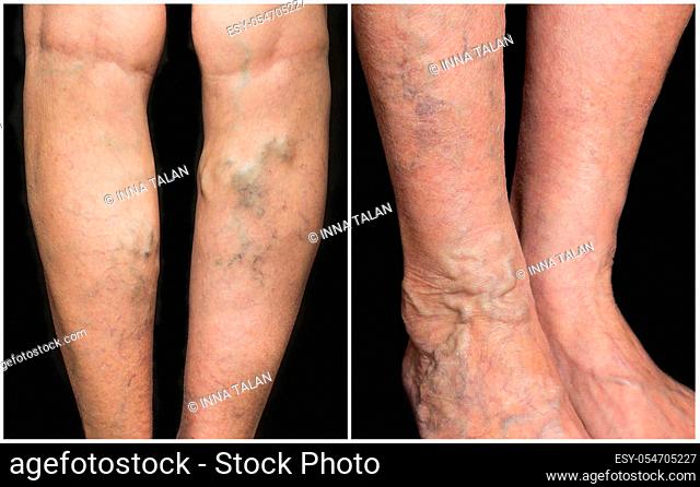 The varicose veins on a legs of old woman on gray