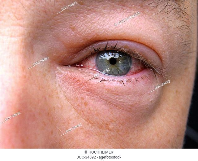 close up view of a heavy inflammation in the eye