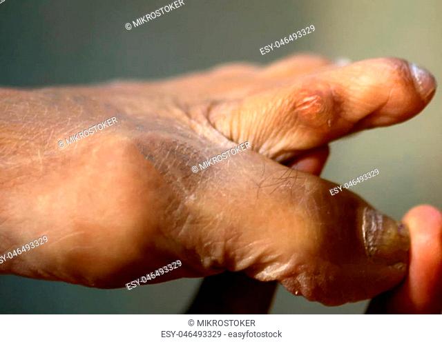 Corn between fingers on the foot. Rubbing on the second toe. Corns on the foot