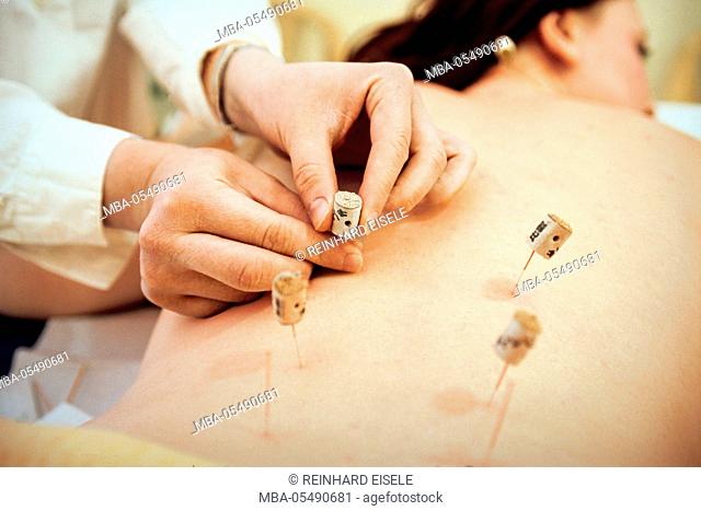 Acupuncture treatment traditional Chinese medicine