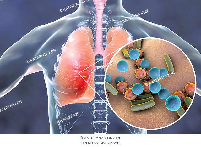 Pneumonia, conceptual illustration
