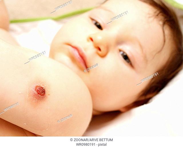 BCG vaccination wound