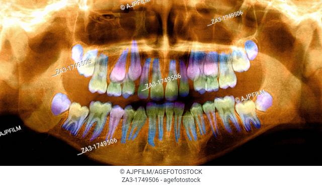 Coloured x-ray of a ten years old boy dentition
