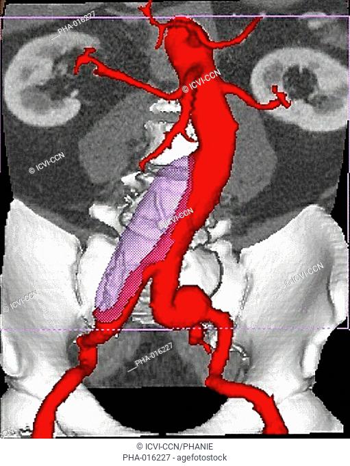 Three-dimensional computed tomographic CT scan reconstruction of aorto-iliac aneurysm. The aneurysm appears as a swollen bulge located on the division of the...
