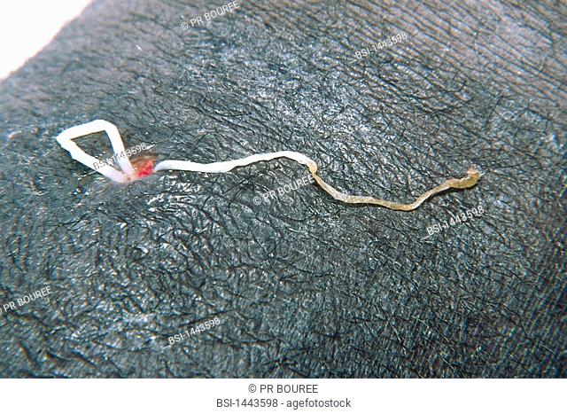 FILARIA<BR>Filaria medinensis, commonly known as the Guinea worm