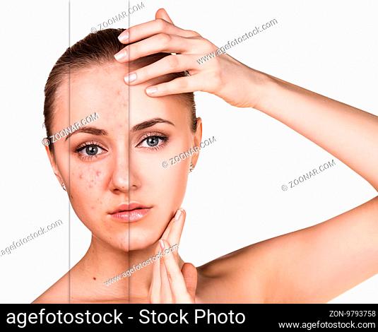 Woman with problem skin on her face before and after treatment over white background