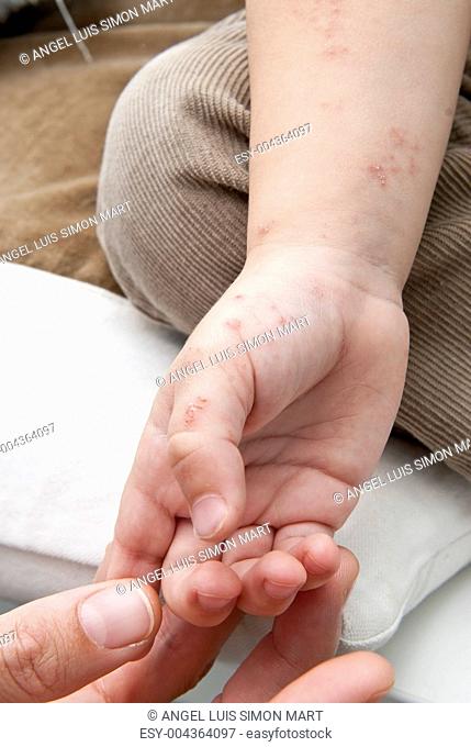 Herpes zoster in a child hand