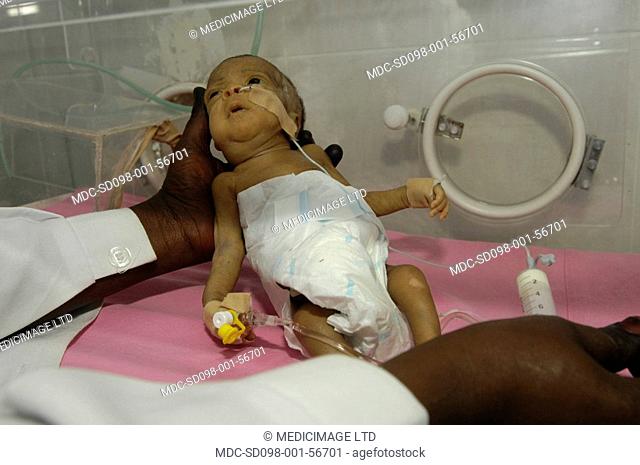 A premature baby being cared for in a premature baby unit