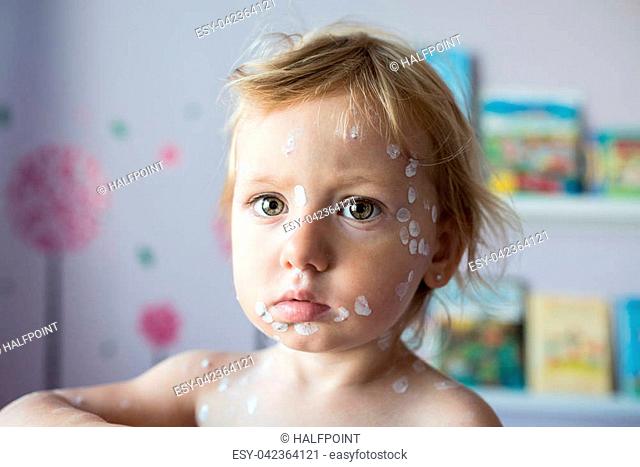 Little two year old girl at home sick with chickenpox, white antiseptic cream applied to the rash