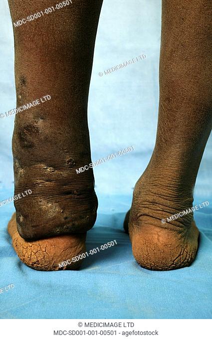 Posterior view of Eumycetoma of the left ankle./n/nMycetoma is an uncommon disease found in the tropics. It is a chronic