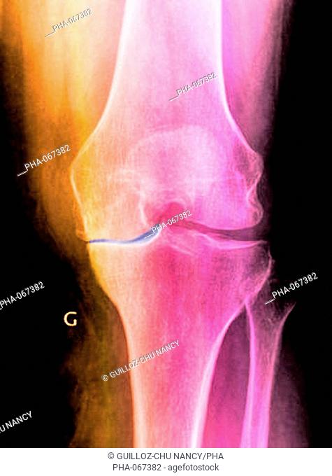 Colored X-ray of the knee showing osteoarthritis or gonarthosis. It has caused a lack of space between the femur thigh bone, above and the tibia shin bone