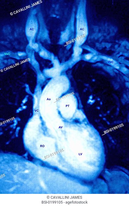 HEART, MRI<BR>Anterior MRI section of the heart and its blood vessels.   LV: left ventricle - AV: aortic valve - Ao: aorta - PT: pulmonary trunk -  AC: carotid...