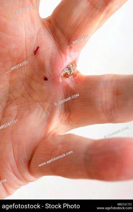 Man injured by dog bites in the hand. The deep wound left by the fangs between the fingers are obvious