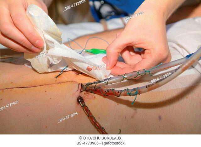 Photo essay from the University Hospital of Bordeaux. Cardiologic hospital of Haut-Leveque. Patient after a cardiac surgery following the rupture of the...