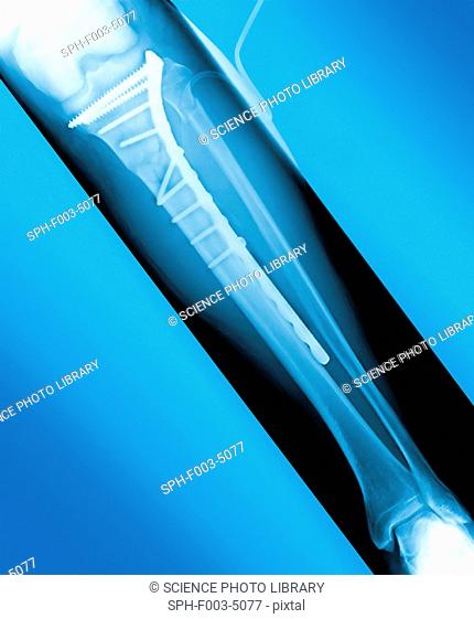 Pinned broken leg. Coloured X-ray of a metal plate and screws in a fractured tibia shin bone