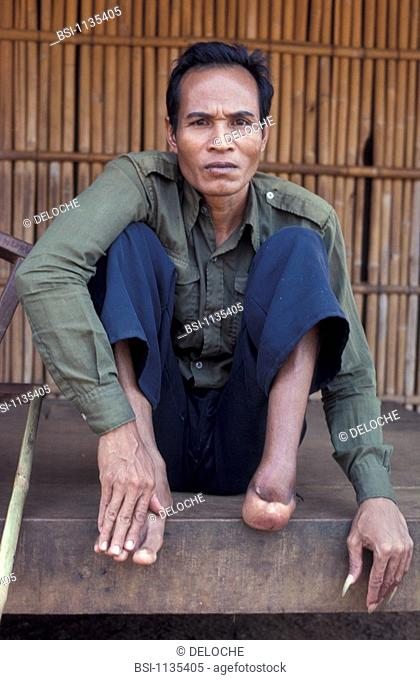 ASIAN MAN<BR>Photo essay for press only.<BR>Victim of an antipersonnel land mine