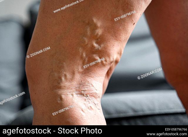 Varicose vein close up leg. Senior woman health problem. Foot with Diseased Veins. Health Care, Podiatry. High quality photo