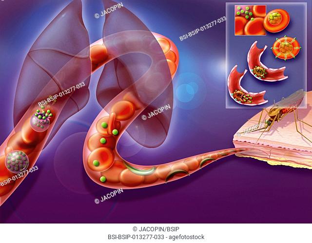 Illustration of the second phase of malaria transmission from one organism to another. The parasites (merozoites) move through blood vessels to the lungs where...
