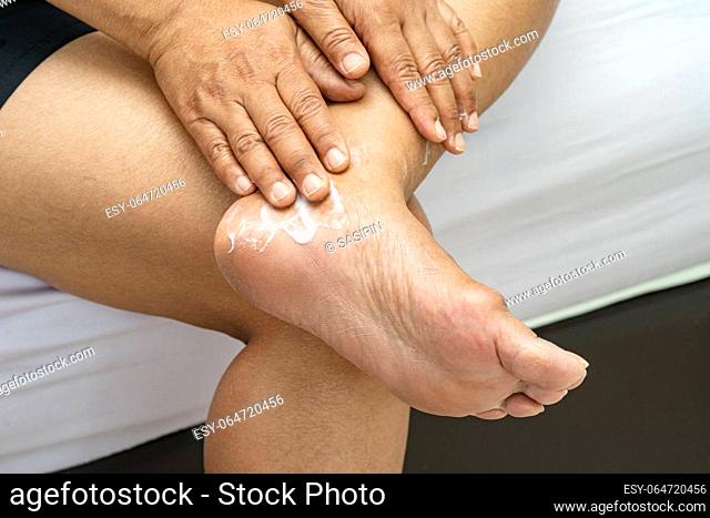 Woman care feet with cracked and dry heel skin cream at home