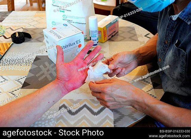 Home nurse for a post-operative dressing on a trigger finger