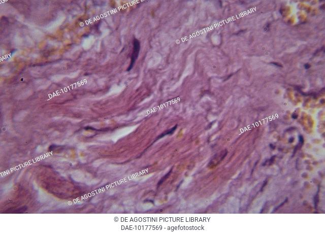 Histological slide of the heart with necrosis of cardiac fibres in myocardial infarction