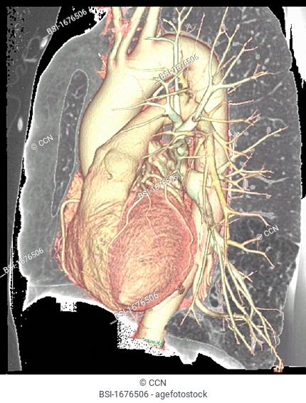 HEART, 3D SCAN Angiography scanner 3D. Visualization of the heart, aortic arch, coronary and pulmonary vascularization arteries and arterioles