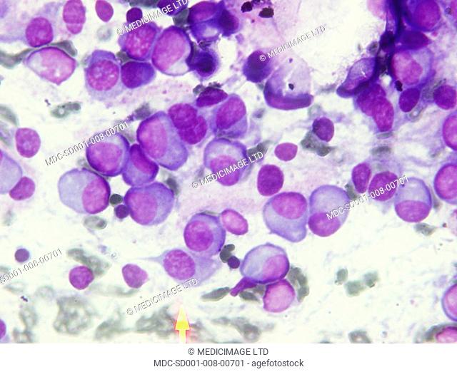 Microscopic image of Multiple Myeloma./n/nMultiple Myeloma is type of cancer, it occurs then a plasma cell becomes abnormal and cancerous