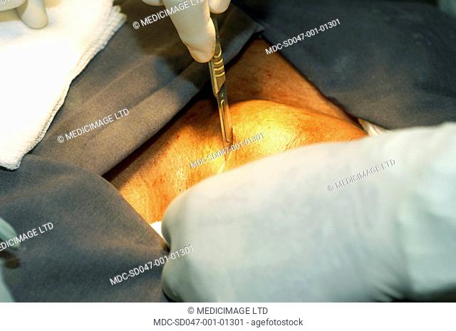 A surgeon makes the the initial incision in a thyroid lobectomy to gain access to the thyroid gland in the neck./n/nA combination of sharp and blunt dissection...