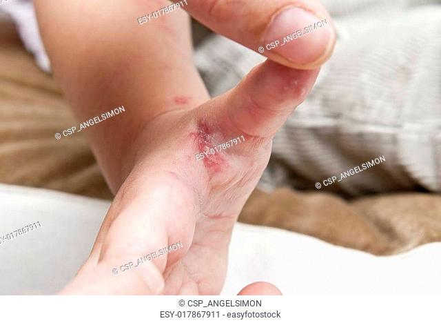 Herpes zoster in a child hand