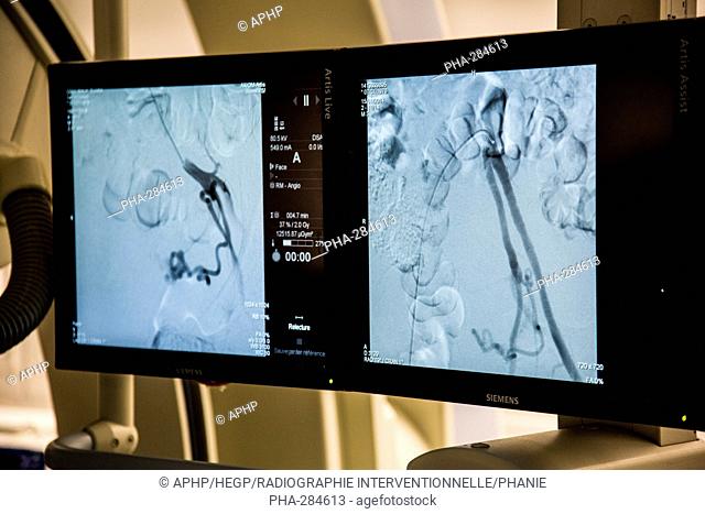 Treatment of uterine leiomyoma by embolization, Hopital Europeen Georges Pompidou (HEGP), AP-HP, Paris, France