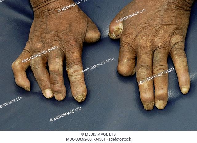 A patient with leprosy is likely to have had the disease for thirty years or more