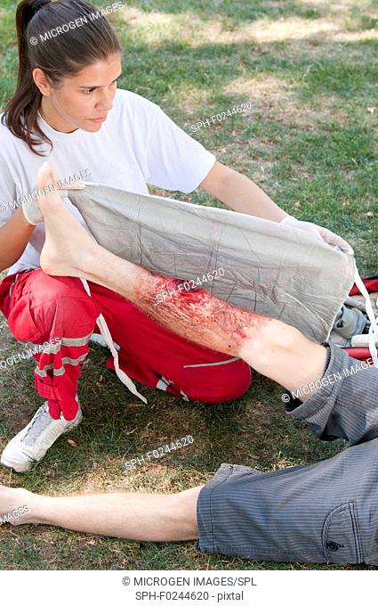 Paramedic placing a bandage on leg of a fire victim with third degree burns. Simulated exercise, realistic medical make-up